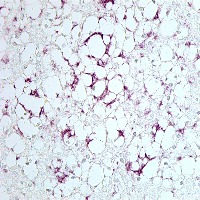 The brain of a patient with Creutzfeldt-Jakob shows signs of neurodegeneration and the presence of  large clumps of prion protein (purple). Courtesy of Lary Walker.
